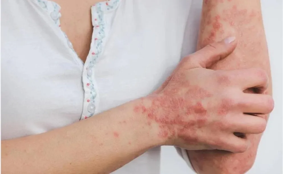Alerta por la viruela del mono: se confirman los primeros casos en Canadá