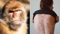 Viruela del mono: estos dos síntomas son claves para detectarla 