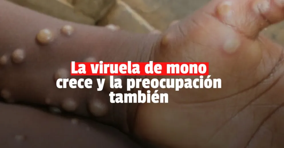 Aumentaron los casos de viruela de mono y hay preocupación en Europa