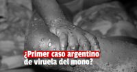 Investigan si un argentino que volvió de Europa se contagió la viruela del mono
