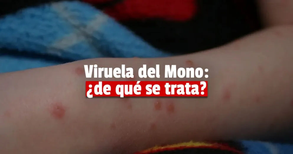 Viruela del Mono: 10 preguntas para entender de qué se trata