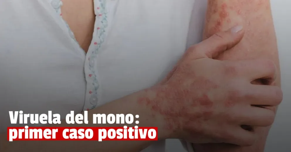 Viruela del mono: confirmaron el primer caso positivo en Argentina