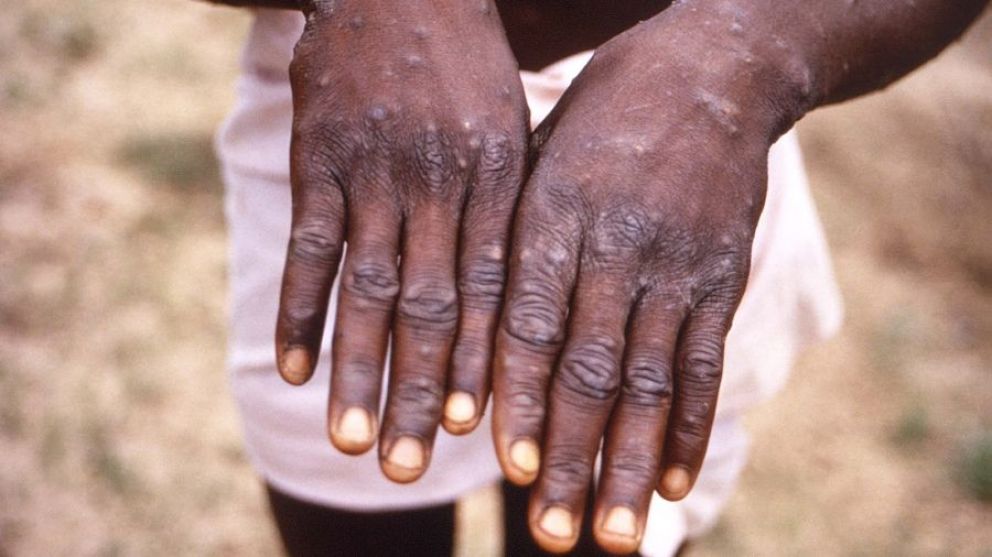 Confirmaron la primera muerte por mpox (viruela símica) en la Argentina