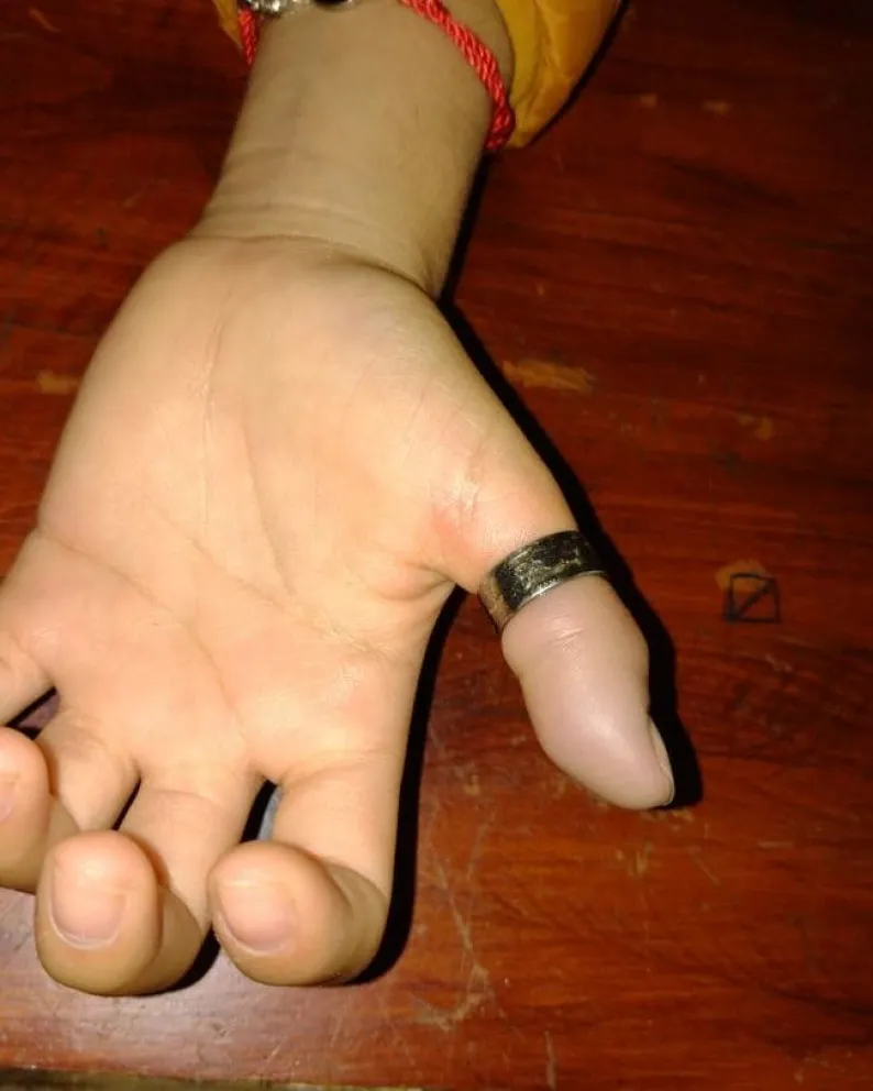 Bomberos ayudaron a sacarle un anillo trabado a una menor