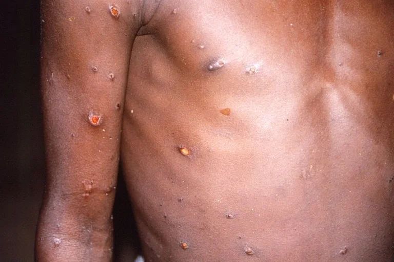 Viruela de Mono: en Río Negro piden que personas con síntomas compatibles, se aíslen