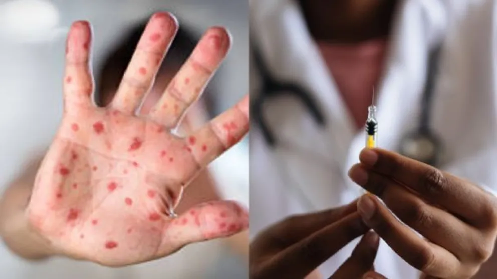 Viruela de mono: ¿Cuál es el tratamiento y qué medicamentos se utilizan?