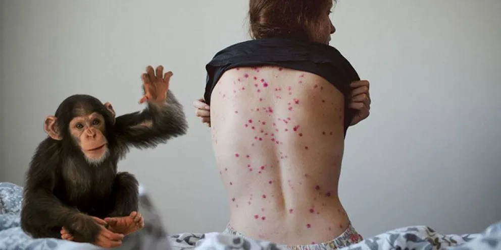 Se confirmó el primer caso de viruela del mono en Argentina y estudian un posible segundo enfermo