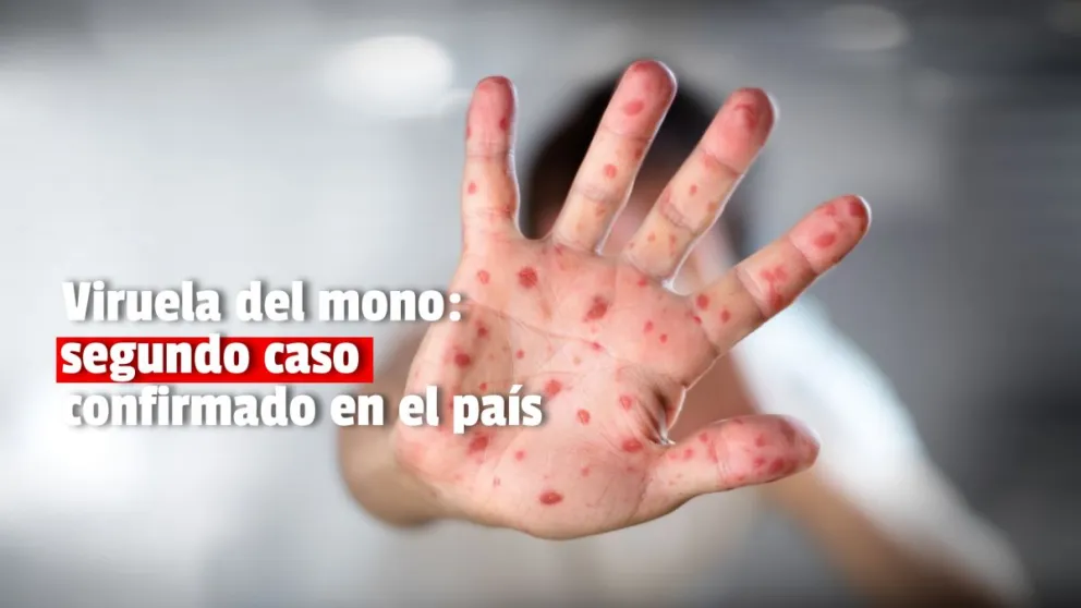 Viruela del mono: segundo caso confirmado en el país