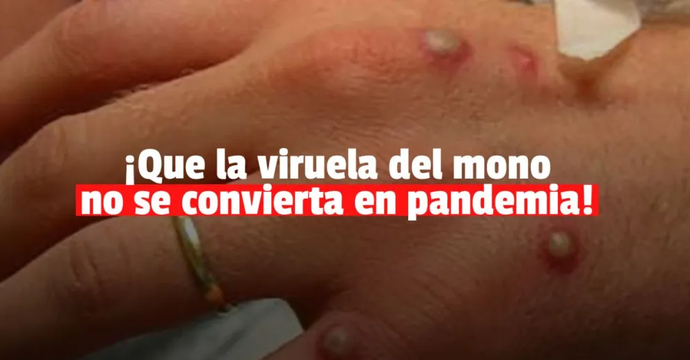 LA OMS busca evitar que la viruela de mono se convierta en pandemia 