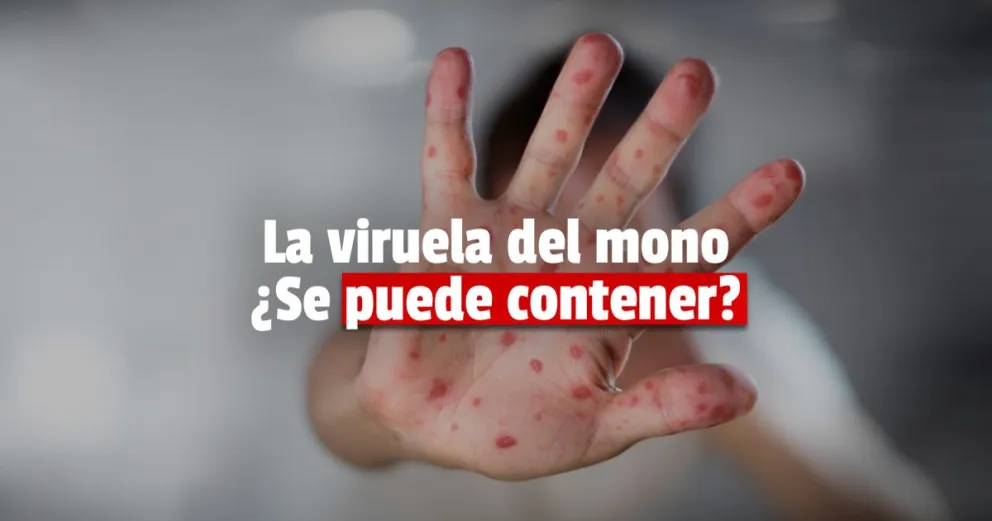Aseguran que la viruela del mono se puede detener antes de ser pandemia 