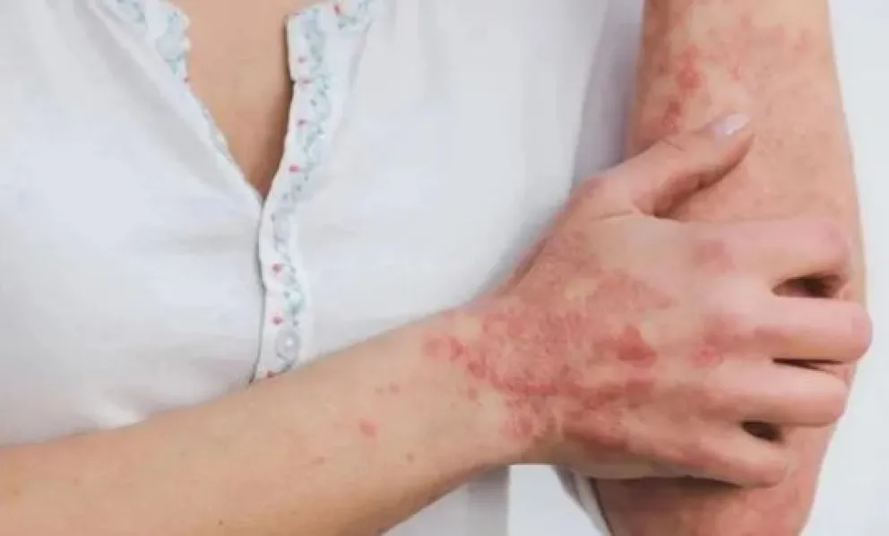 La OMS descartó que la viruela del mono se convierta en una pandemia
