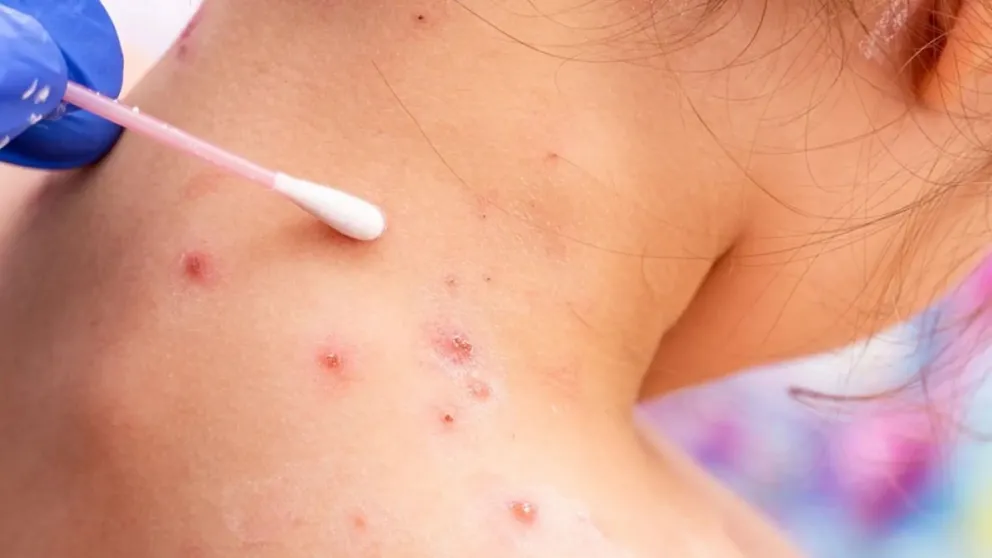Viruela del mono: la OMS confirmó 780 casos en 27 países donde el virus no es endémico