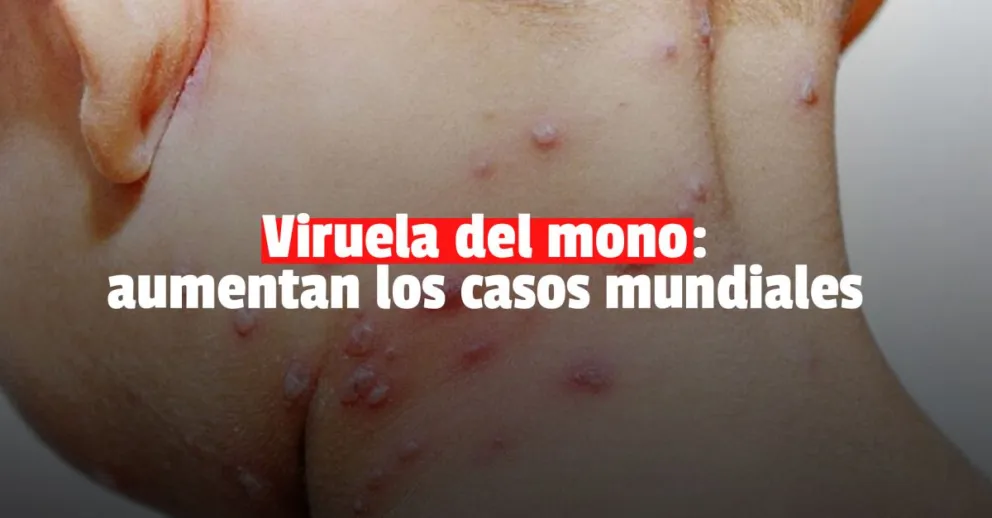 Viruela del mono: la OMS confirma 780 casos en 27 países