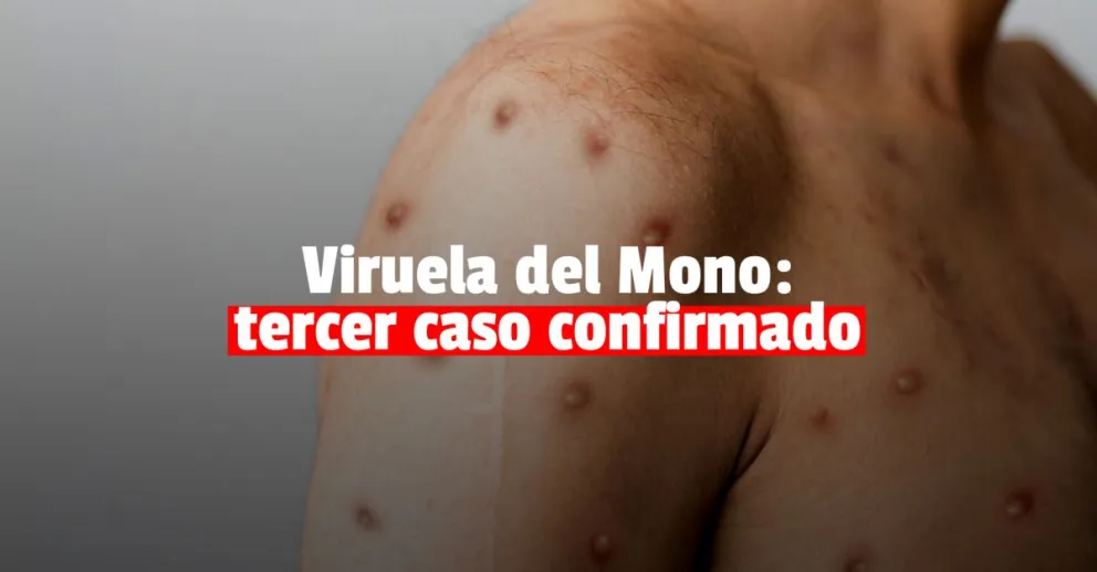 Viruela del Mono: confirman el tercer caso en el país, sin antecedentes de viaje