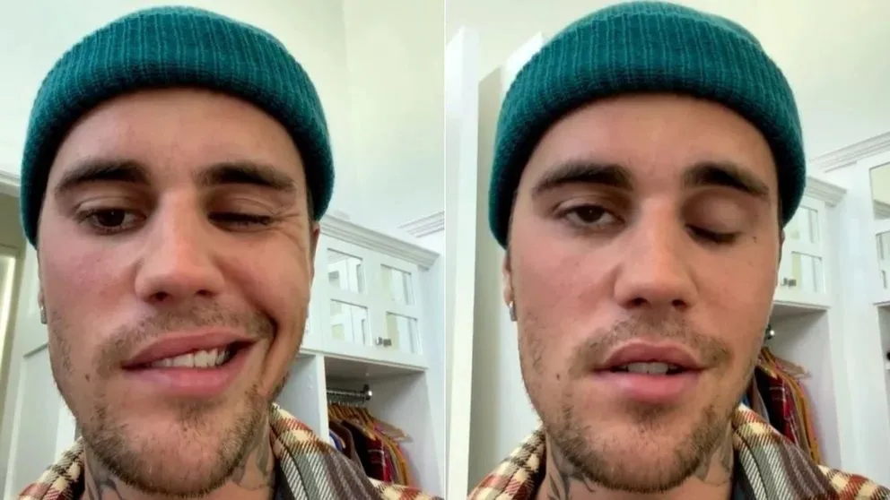 Justin Bieber tiene la mitad de su rostro paralizado por el síndrome de Ramsay Hunt