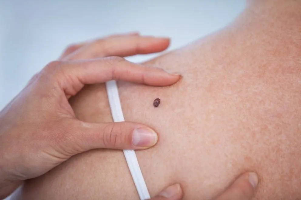 Día del cáncer de piel: cómo prevenirlo y la importancia de la detección precoz