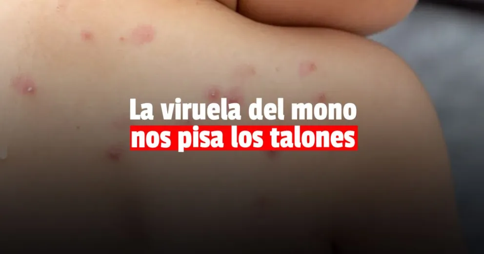 Viruela del mono: hay un caso sospechoso en Mendoza y enviarán muestras al Malbrán