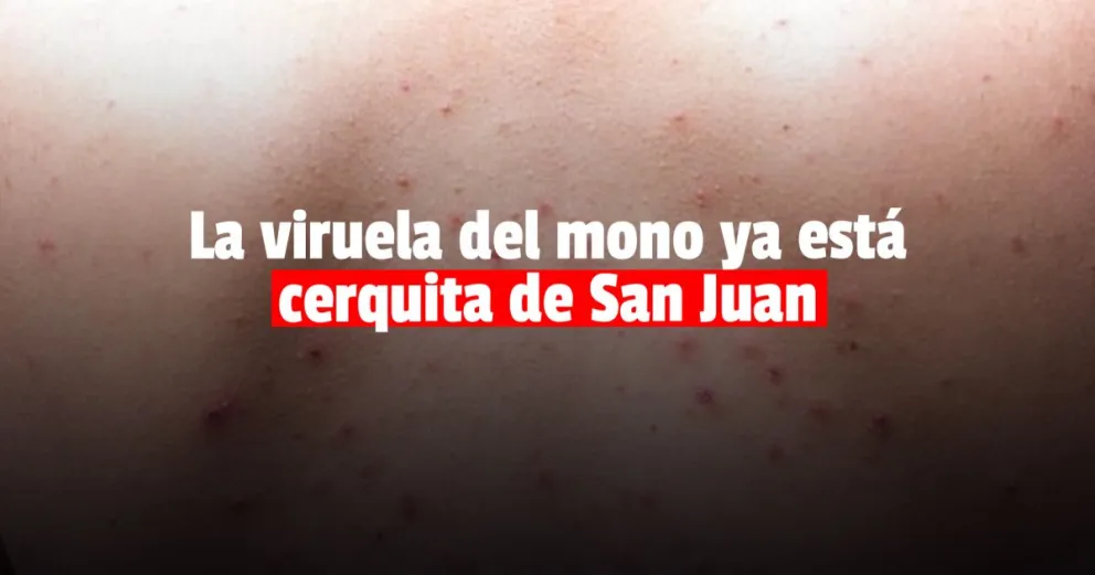 Confirmaron el primer caso de la viruela del mono en Mendoza