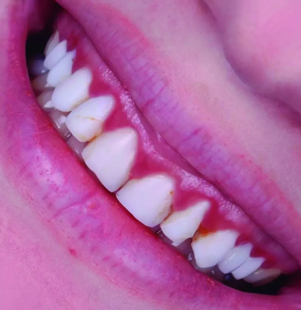 Estética de las encías