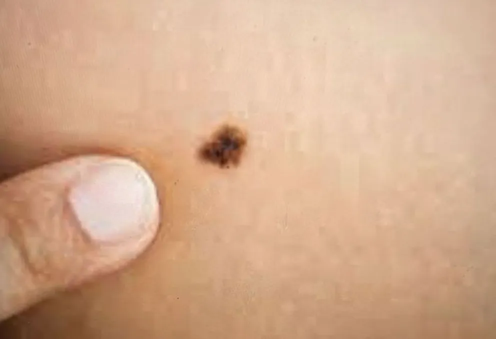 14 de Junio Día Mundial del Cáncer de Piel