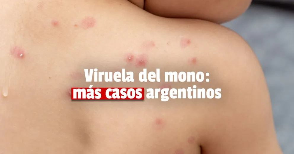 Confirmación: crece la viruela