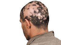 Alopecia Areata Universal. ¿De qué habla el Mundo?